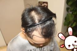 点击看大图 -大麦微针植发丨全国连锁