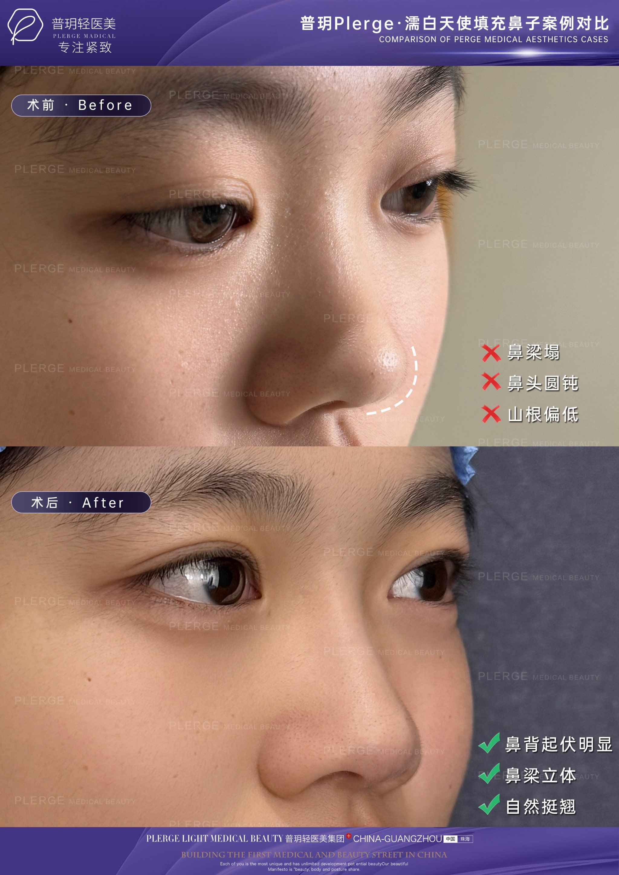 濡白天使填充鼻子案例对比 
不刀刀