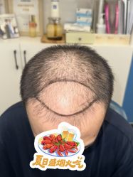 点击看大图 -大麦微针植发全国连锁
