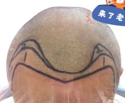 -大麦微针植发全国连锁