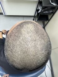-大麦微针植发全国连锁