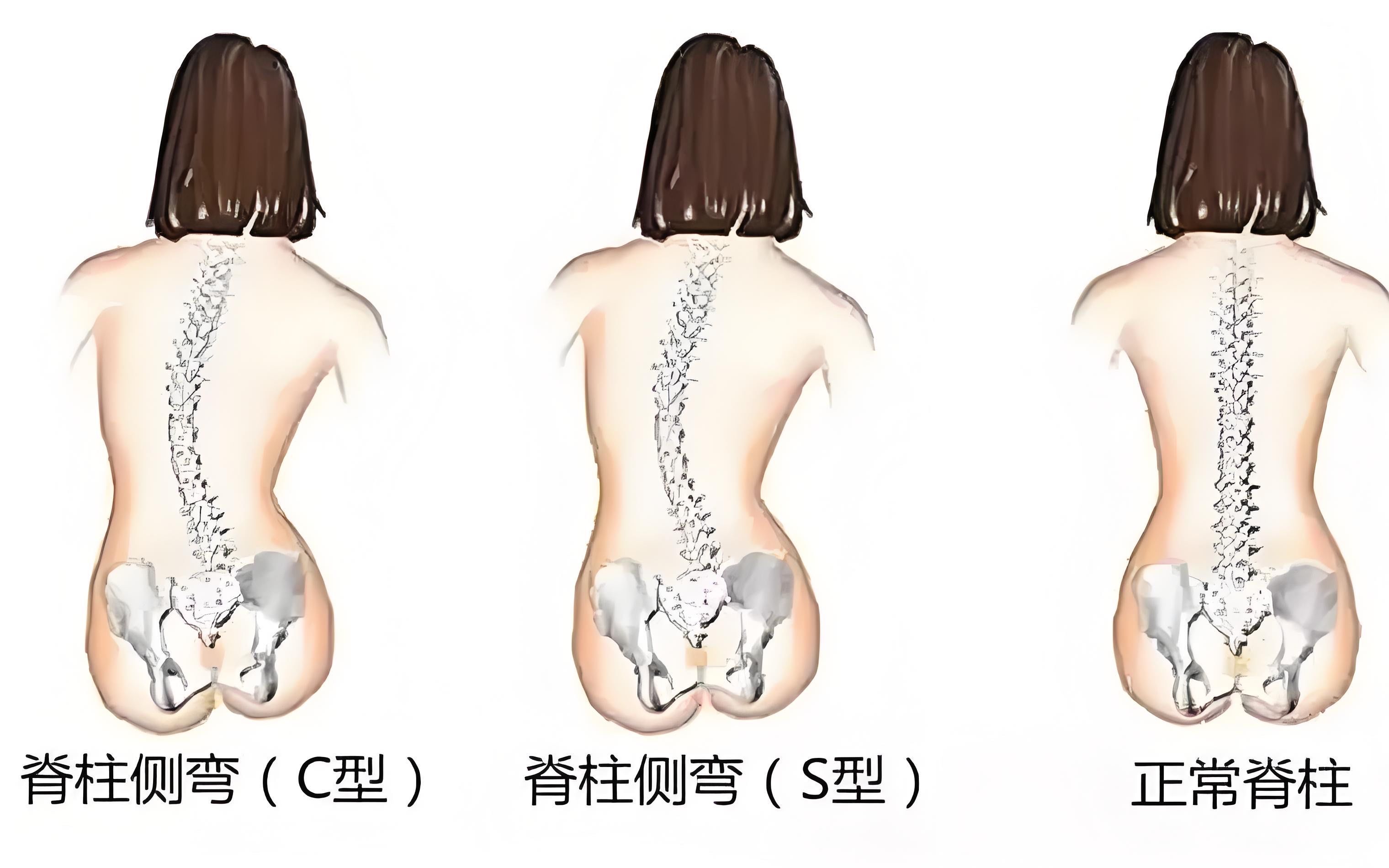 脊柱侧弯不用慌,专业康复来帮忙.科学训练