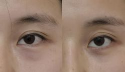 -广州健丽·去眼袋医疗美容机构
