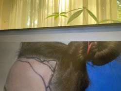 -碧莲盛·不剃发植发