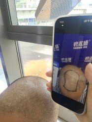 -碧莲盛·不剃发植发