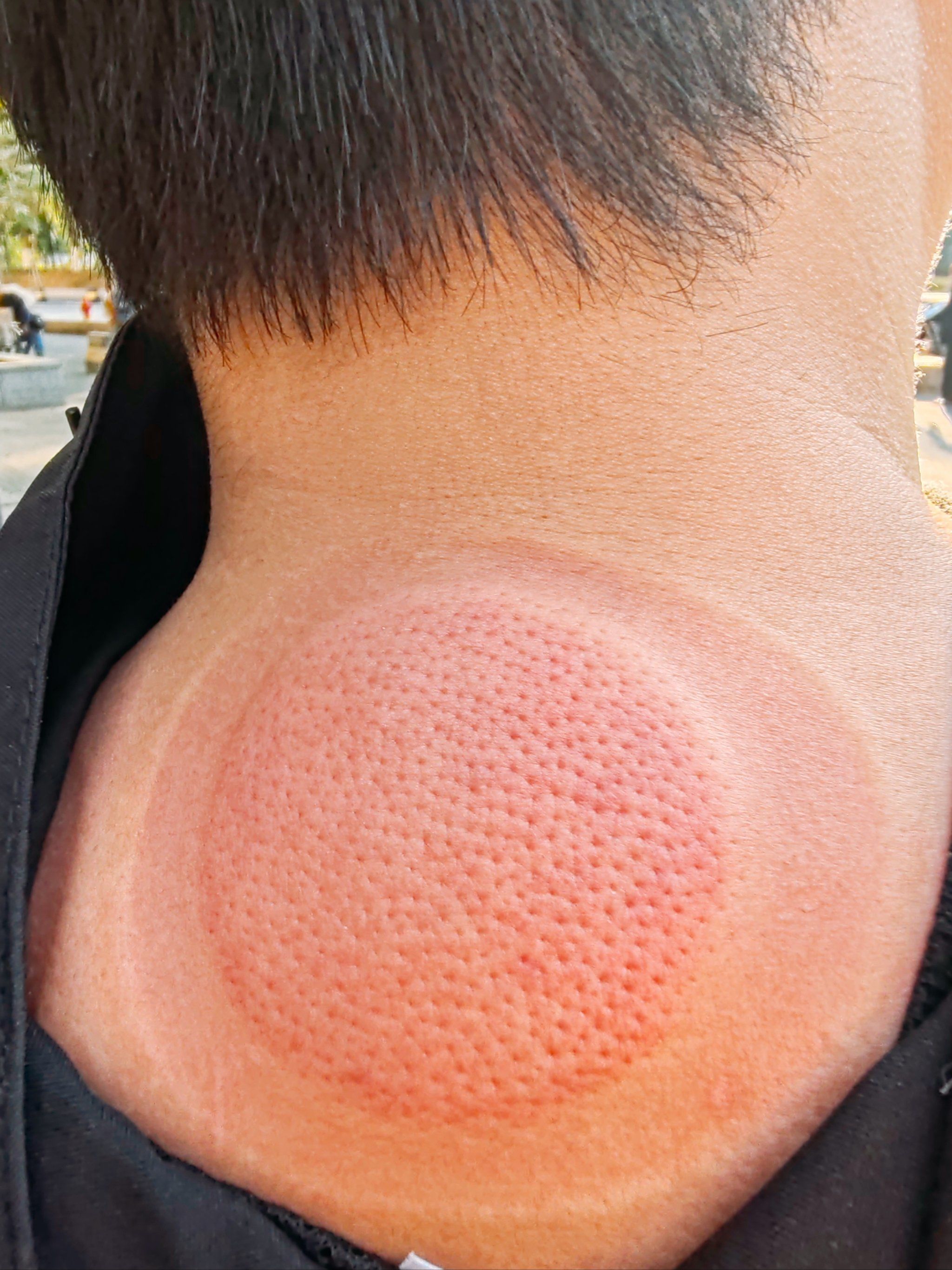 拔罐疗法,中医也能时尚!