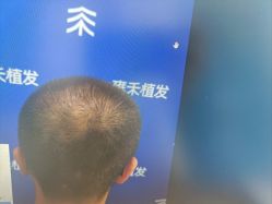 -雍禾植发全国连锁