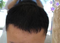 -大麦微针植发丨全国连锁