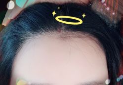 -大麦微针植发全国连锁