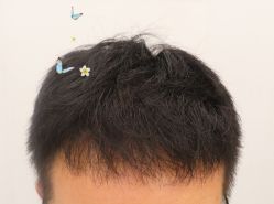 -大麦微针植发全国连锁