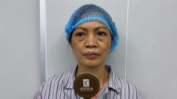 点击看大图 体验前-广州健丽·去眼袋医疗美容机构