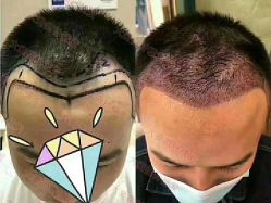 点击看大图 -大麦微针植发丨全国连锁