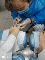 -派恩宜灰指甲鸡眼嵌甲手足癣