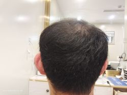 点击看大图 -碧莲盛·不剃发植发