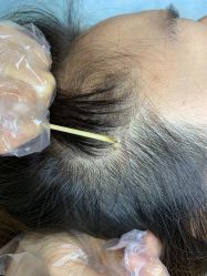 -美丽人生祛斑扁平疣汗管瘤中心