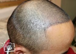 -大麦微针植发丨全国连锁