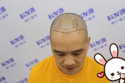 点击看大图 -大麦微针植发丨全国连锁