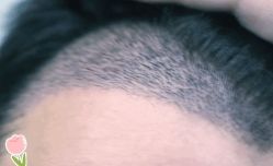 -大麦微针植发丨全国连锁