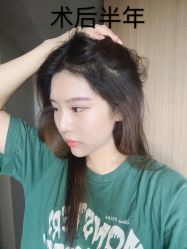 体验后-雍禾植发全国连锁