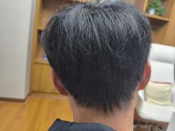 体验后-大麦微针植发全国连锁