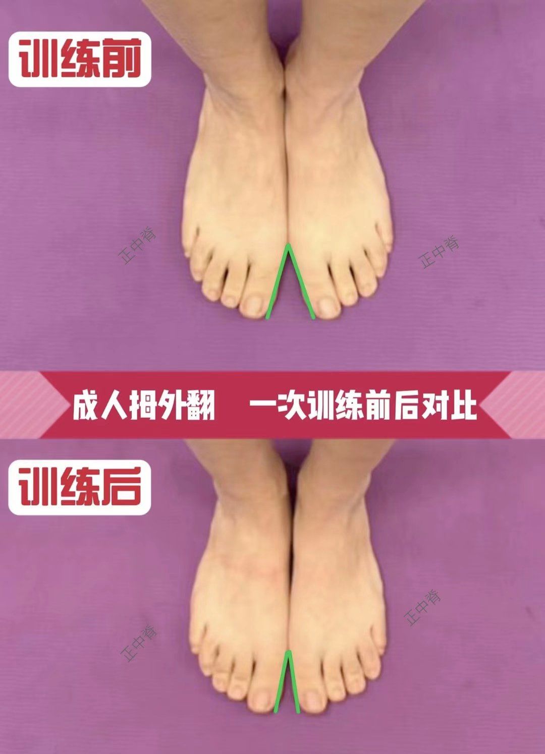 正中脊一次调整拇外翻