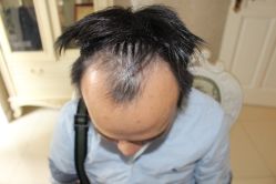 -大麦微针植发丨全国连锁