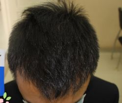 -大麦微针植发丨全国连锁