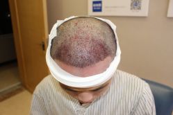 -大麦微针植发丨全国连锁