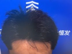 -雍禾植发全国连锁