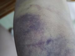 -广州中医药大学第三附属医院(骨伤科分院)