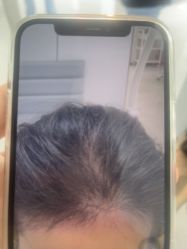 -大麦微针植发丨全国连锁