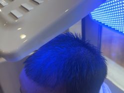 -碧莲盛·不剃发植发