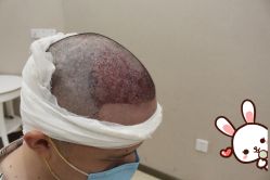 -大麦微针植发丨全国连锁