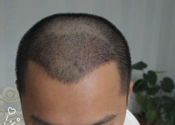 -大麦微针植发丨全国连锁