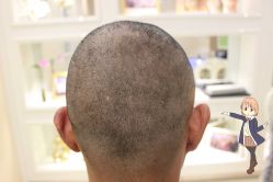 -大麦微针植发丨全国连锁