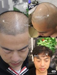 -大麦微针植发全国连锁