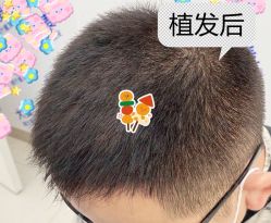 -大麦微针植发全国连锁