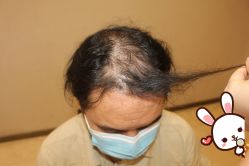 -大麦微针植发丨全国连锁