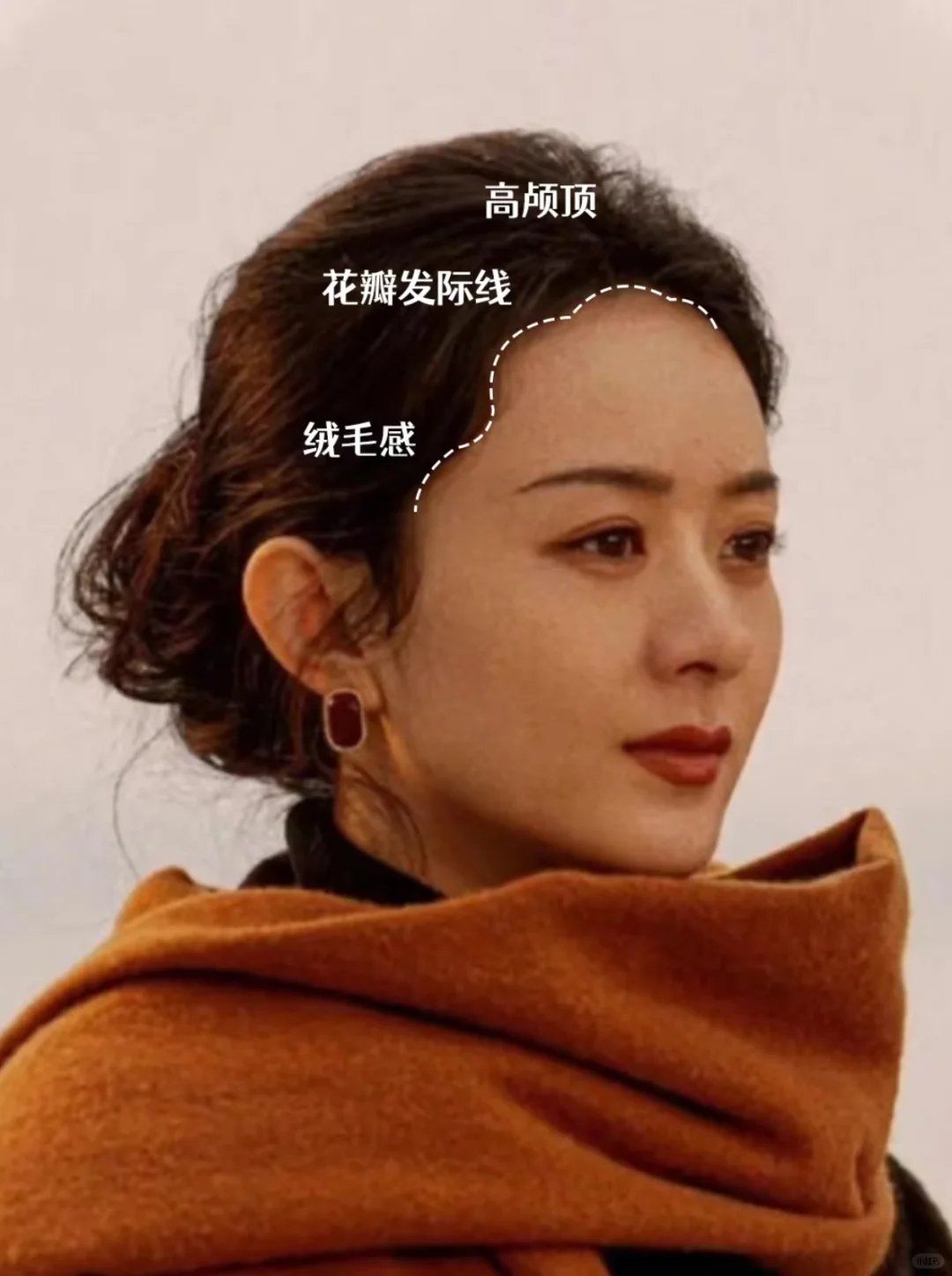 妈生感的发际线怎么植