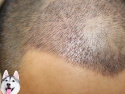 -大麦微针植发丨全国连锁