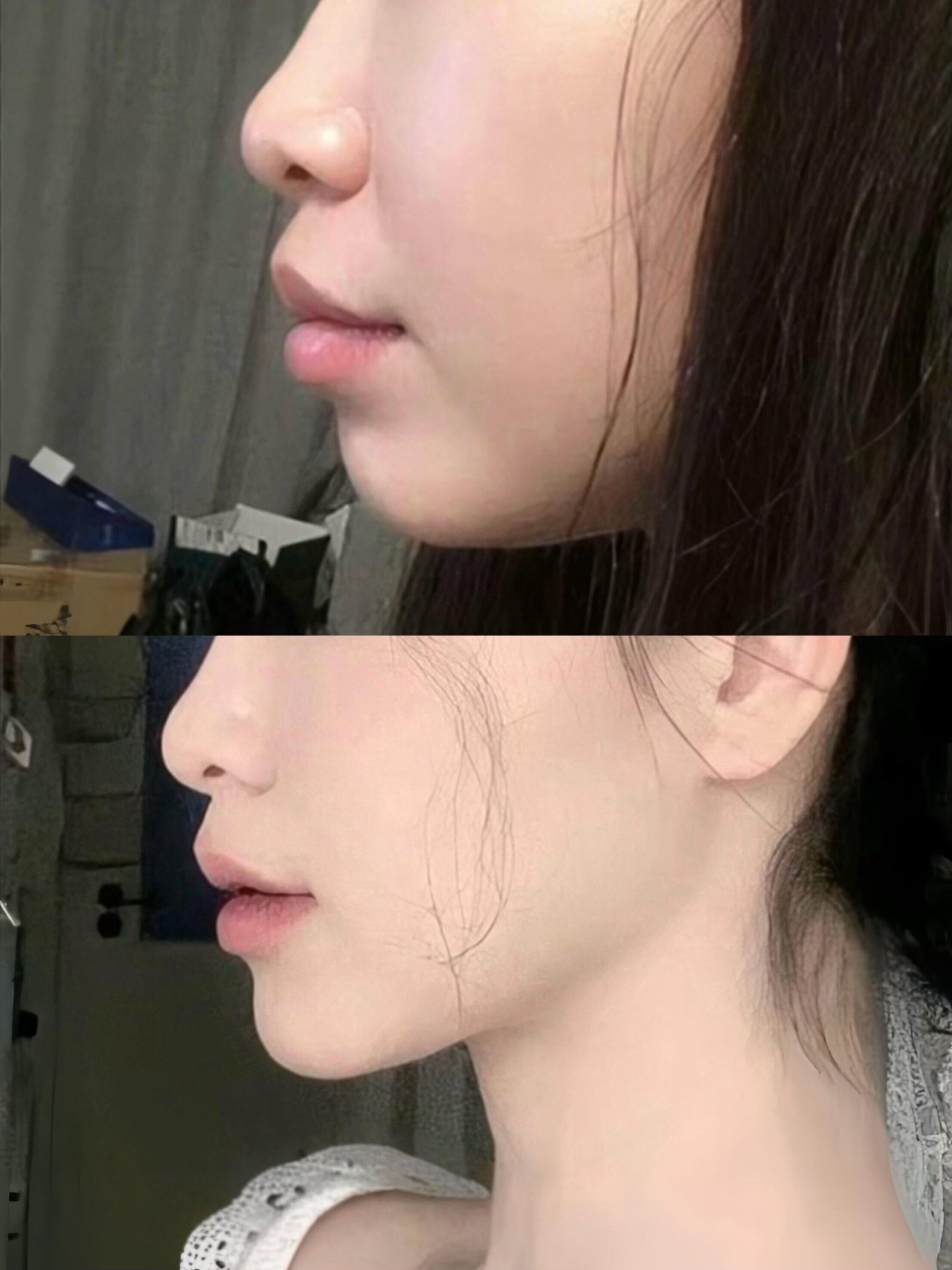 戴牙套前后的侧脸,区别还是挺明显的