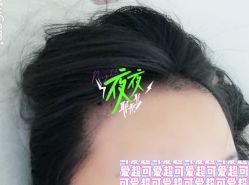 -大麦微针植发全国连锁