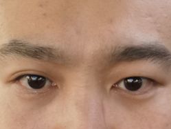 体验前-新美荟医美·专注面部美学抗衰
