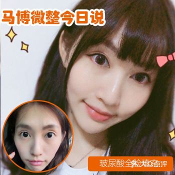 为什么玻尿酸丰苹果肌这么受欢迎？