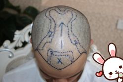 点击看大图 -大麦微针植发丨全国连锁