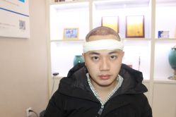 -大麦微针植发丨全国连锁