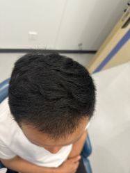-大麦微针植发全国连锁