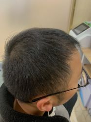 -碧莲盛·不剃发植发