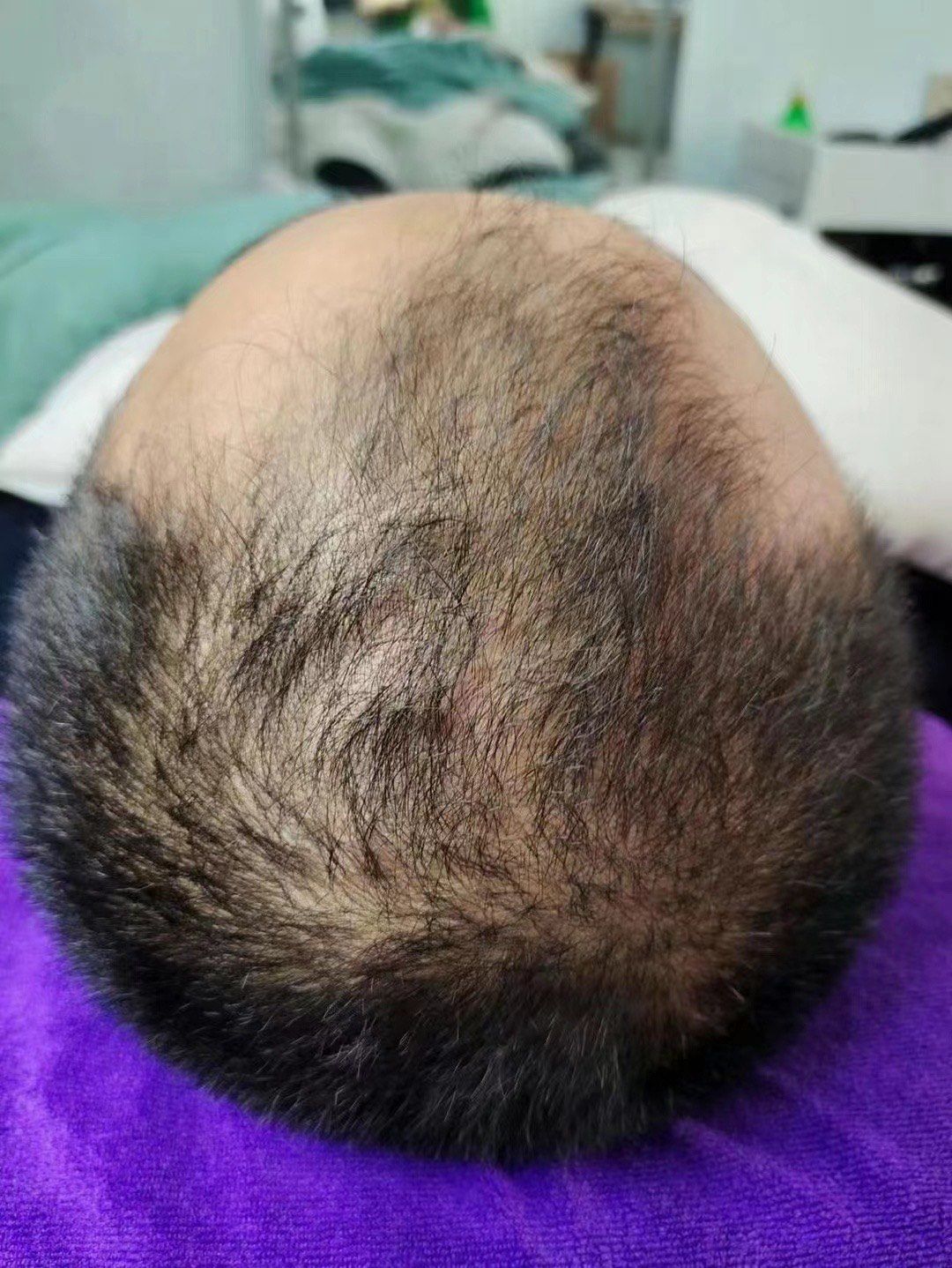 72脱发如果超过一年不养护,毛囊就会萎缩.
