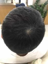 -大麦微针植发全国连锁